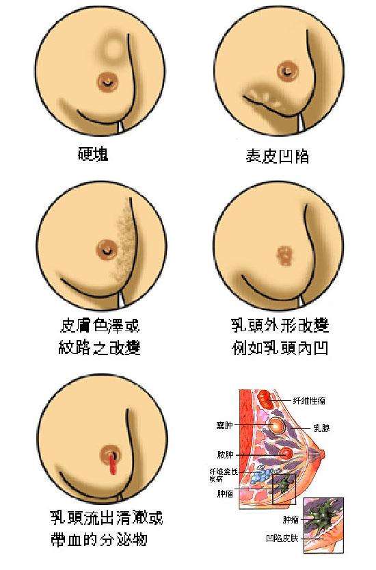 你对乳腺癌了解有多少?一个人人都应知道的乳腺癌科普 你对乳腺癌了解有多少?一个人人都应知道的乳腺癌科普